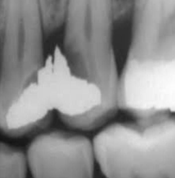 Le syndrome du septum interradiculaire : définition, diagnostic et prise en charge complète