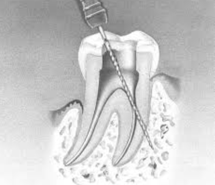Perforations Radiculaires : Prévention, Détection et Réparation